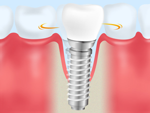 【インプラント周囲炎】