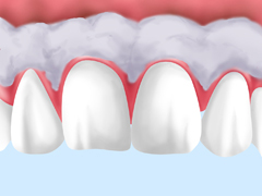 ガムピーリング（歯肉ピーリング）